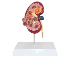 kidney disease